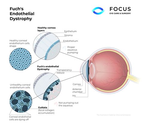 Gain Expert Advice for Fuchs' Dystrophy: Find Hope and Relief with an Optometrist